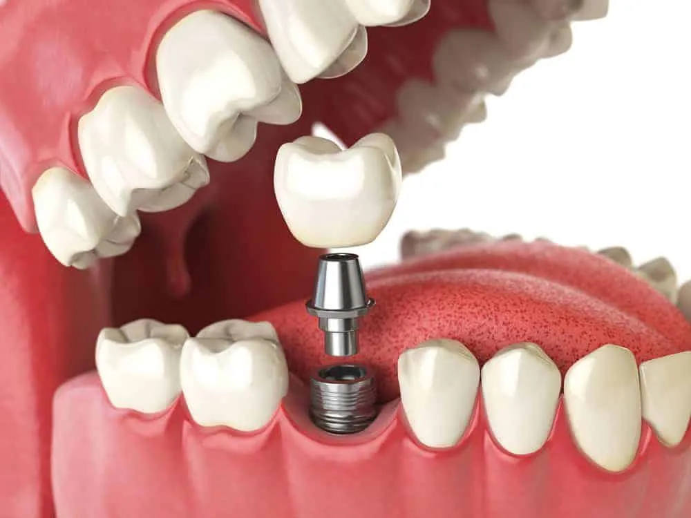 Dental implants at Rio Hondo Dental in Downey