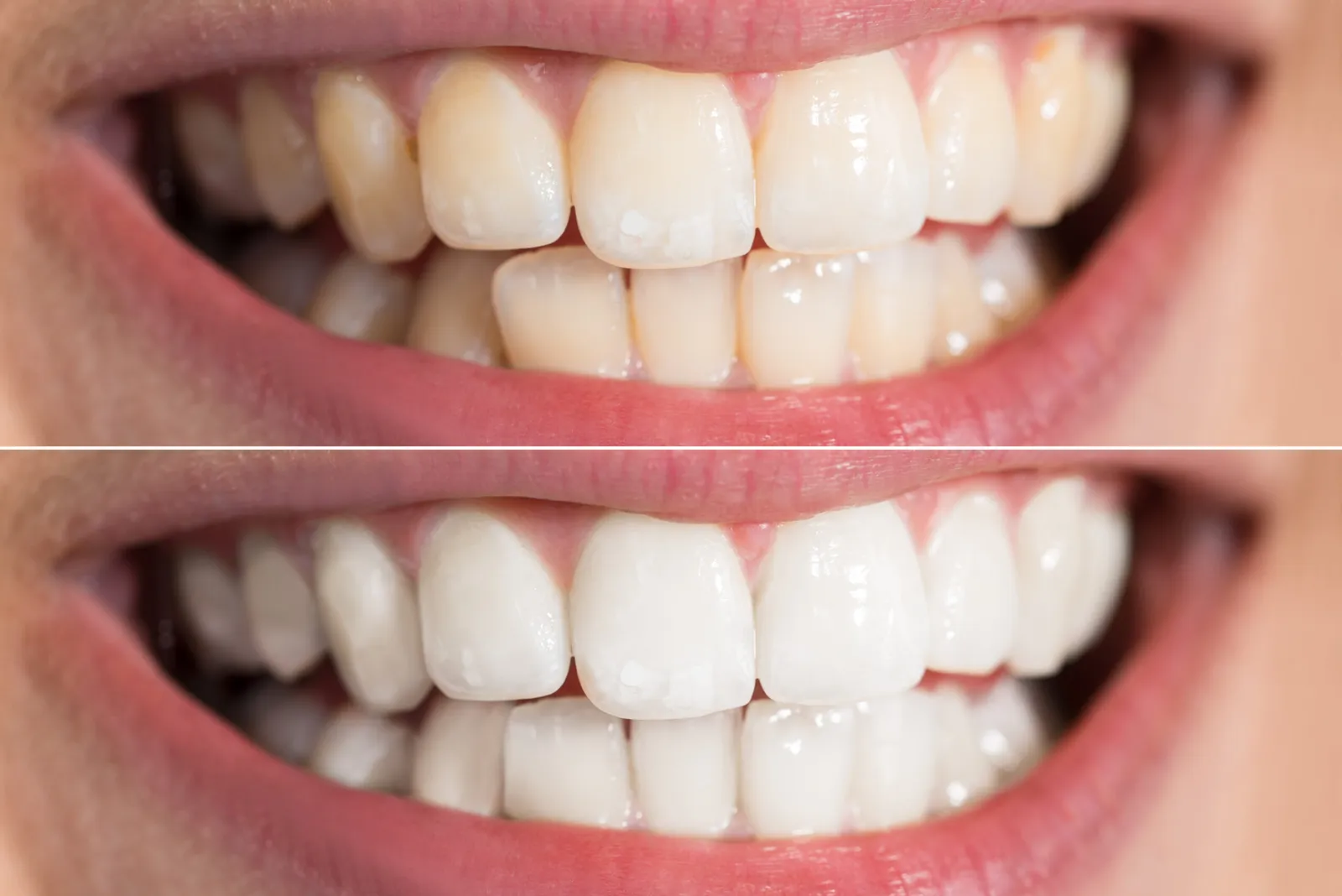 Whitening in Downey: In-Office vs. Take-Home—How to Keep Results Longer
