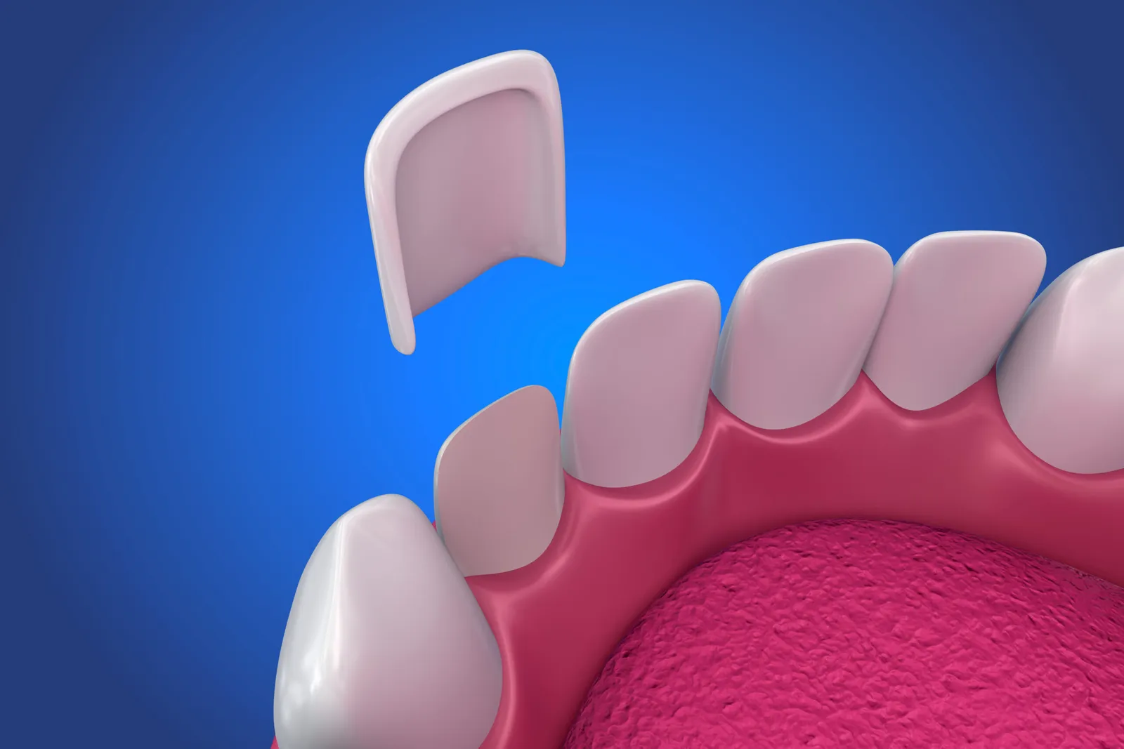 Veneers vs. Whitening: Which Smile Upgrade Is Right for Downey Professionals?