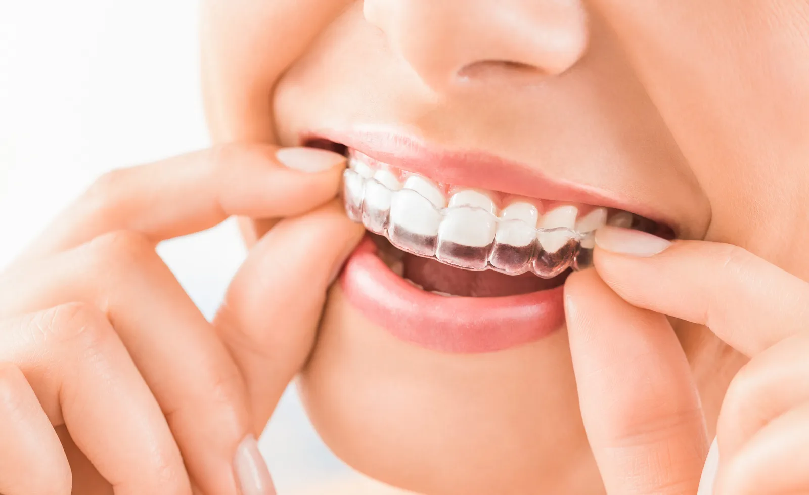 😁 Braces for Adults in Downey: It’s Never Too Late for a Confident Smile