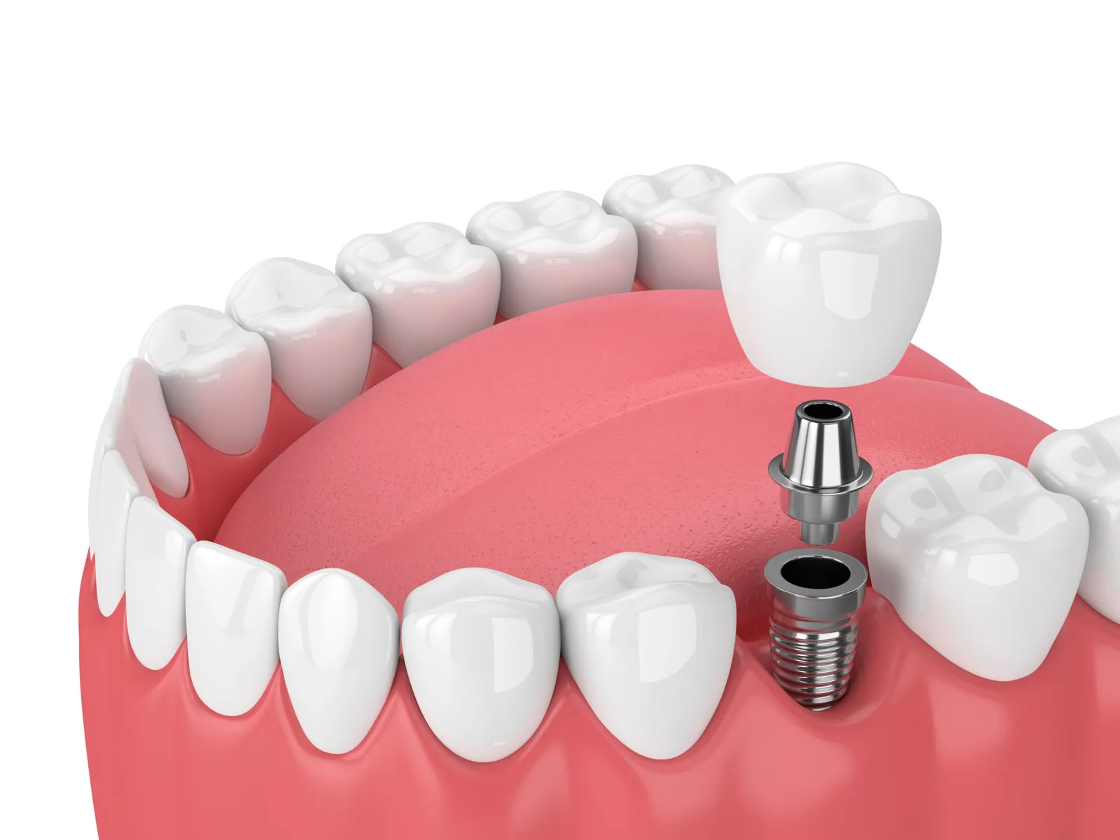 Dental Implants in Downey: Candid Costs, Timelines, and Financing (CareCredit Guide)