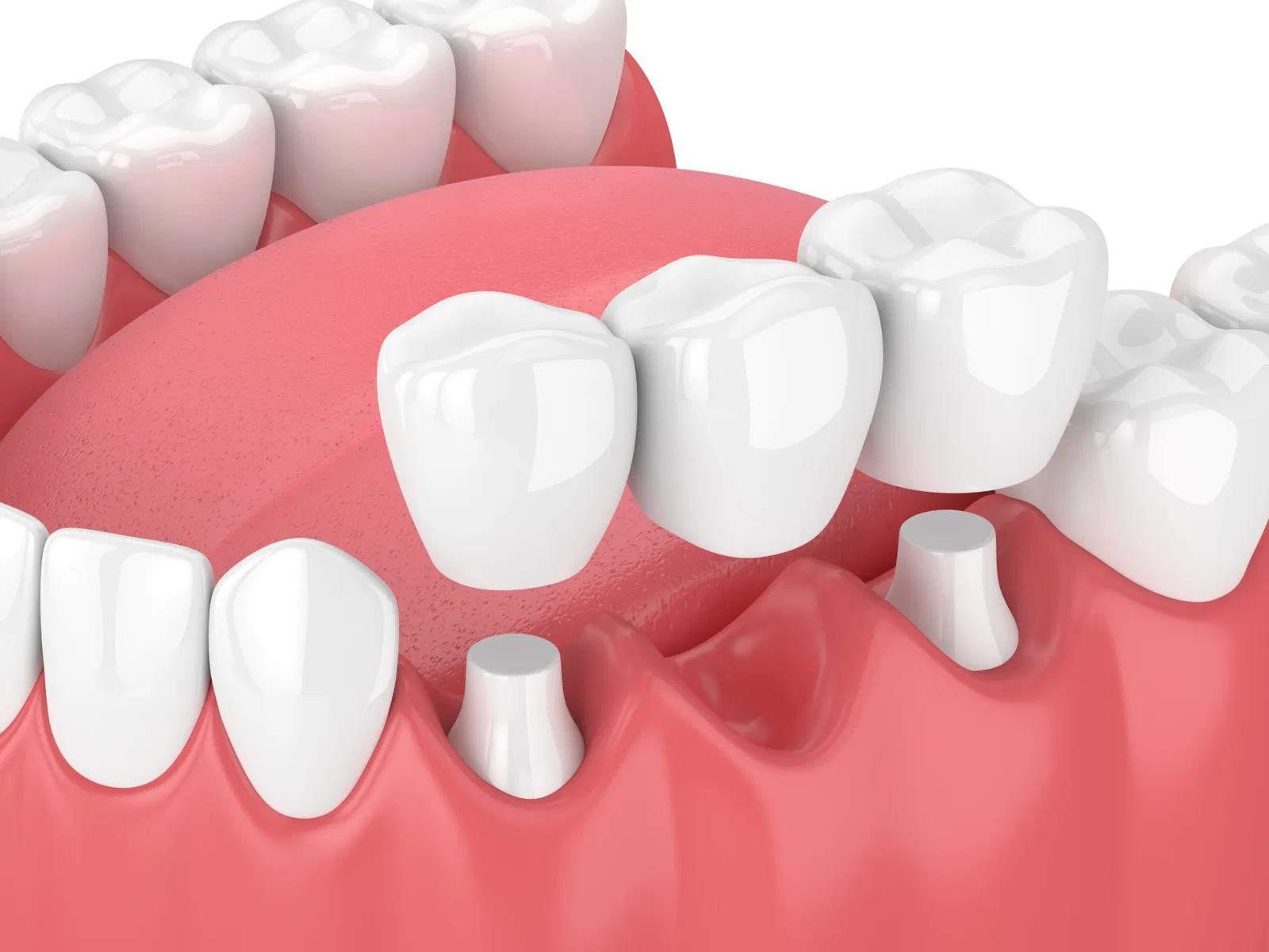 Dental Implants vs Bridges: Which Do Downey Dentists Recommend and Why?