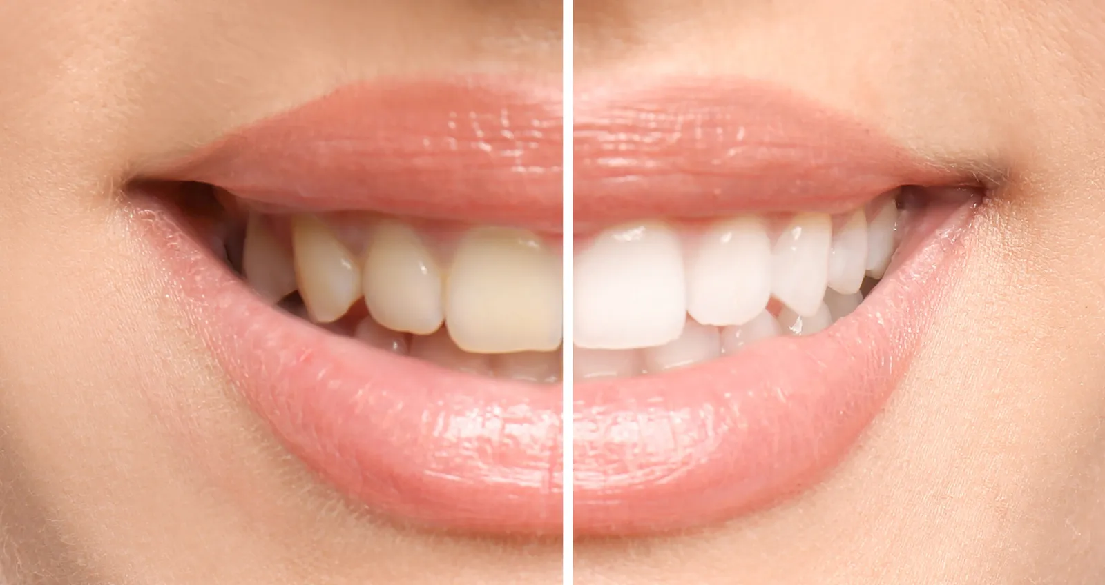 Why Downey Residents Love In-Office Whitening Before Holidays and Events