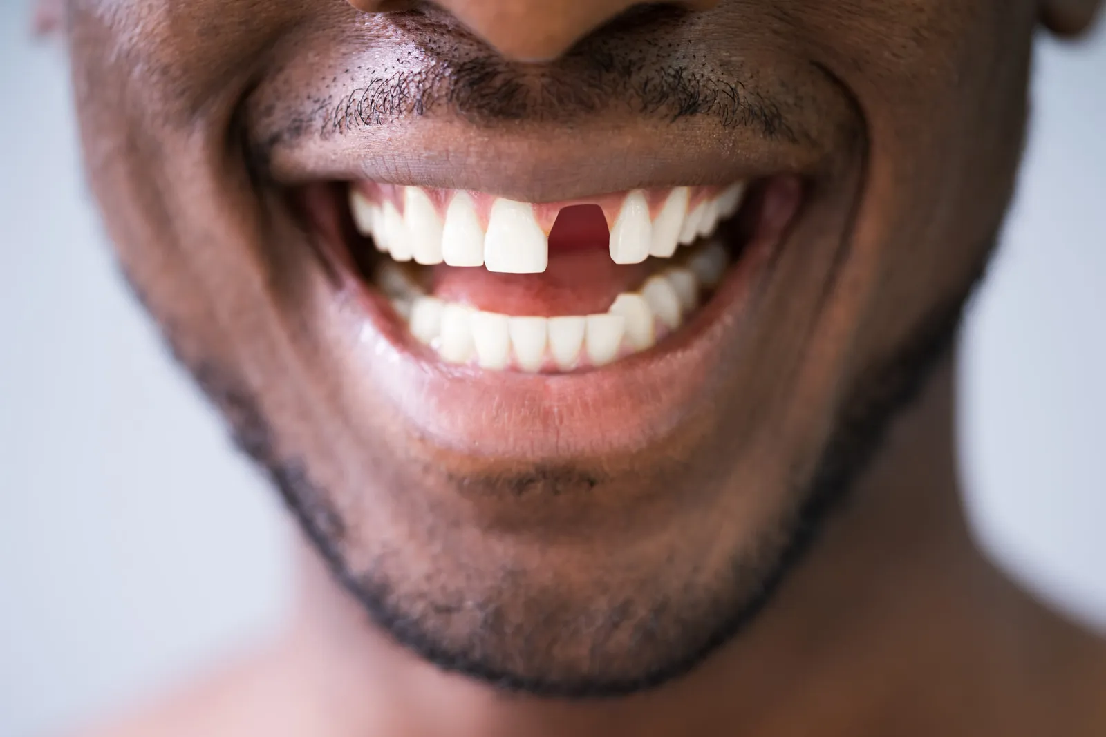 Emergency Dentist in Downey: Exact Steps to Follow for Pain, Cracked Teeth &amp; Swelling