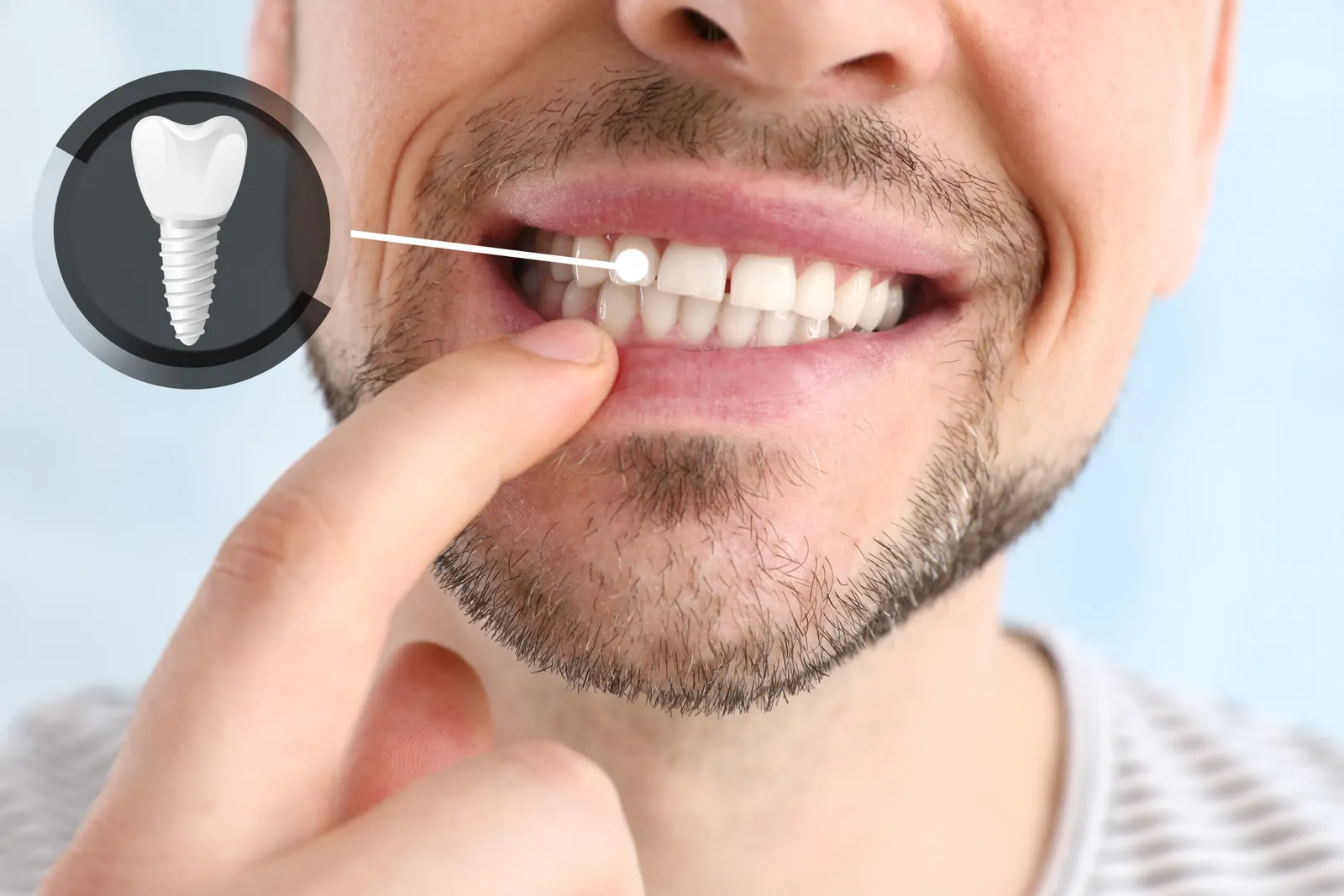 Cracked Tooth? Crown vs. Onlay vs. Veneer—What We Recommend in Downey
