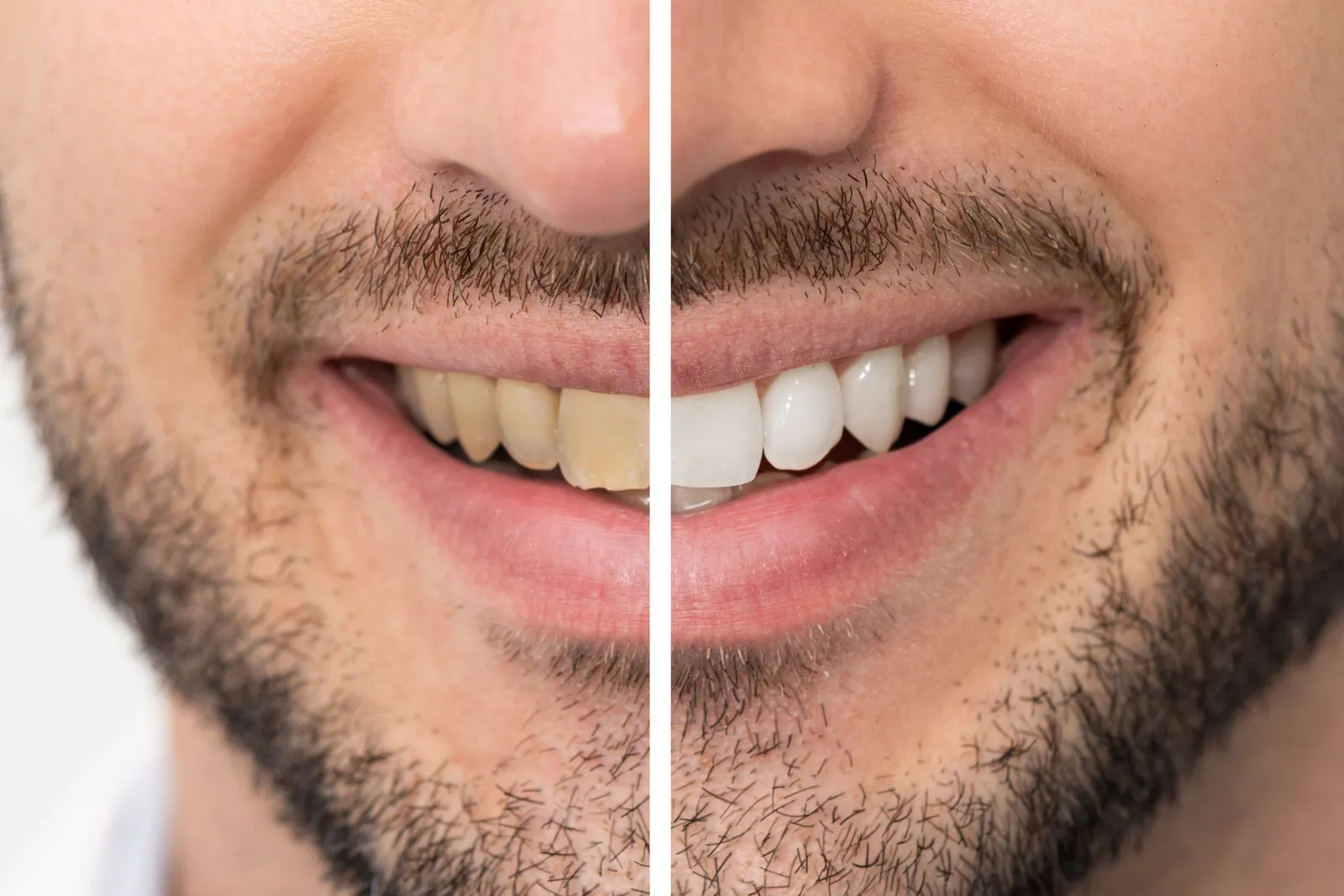 Want a Whiter Smile for the Holidays? Downey Dentist Timeline Guide