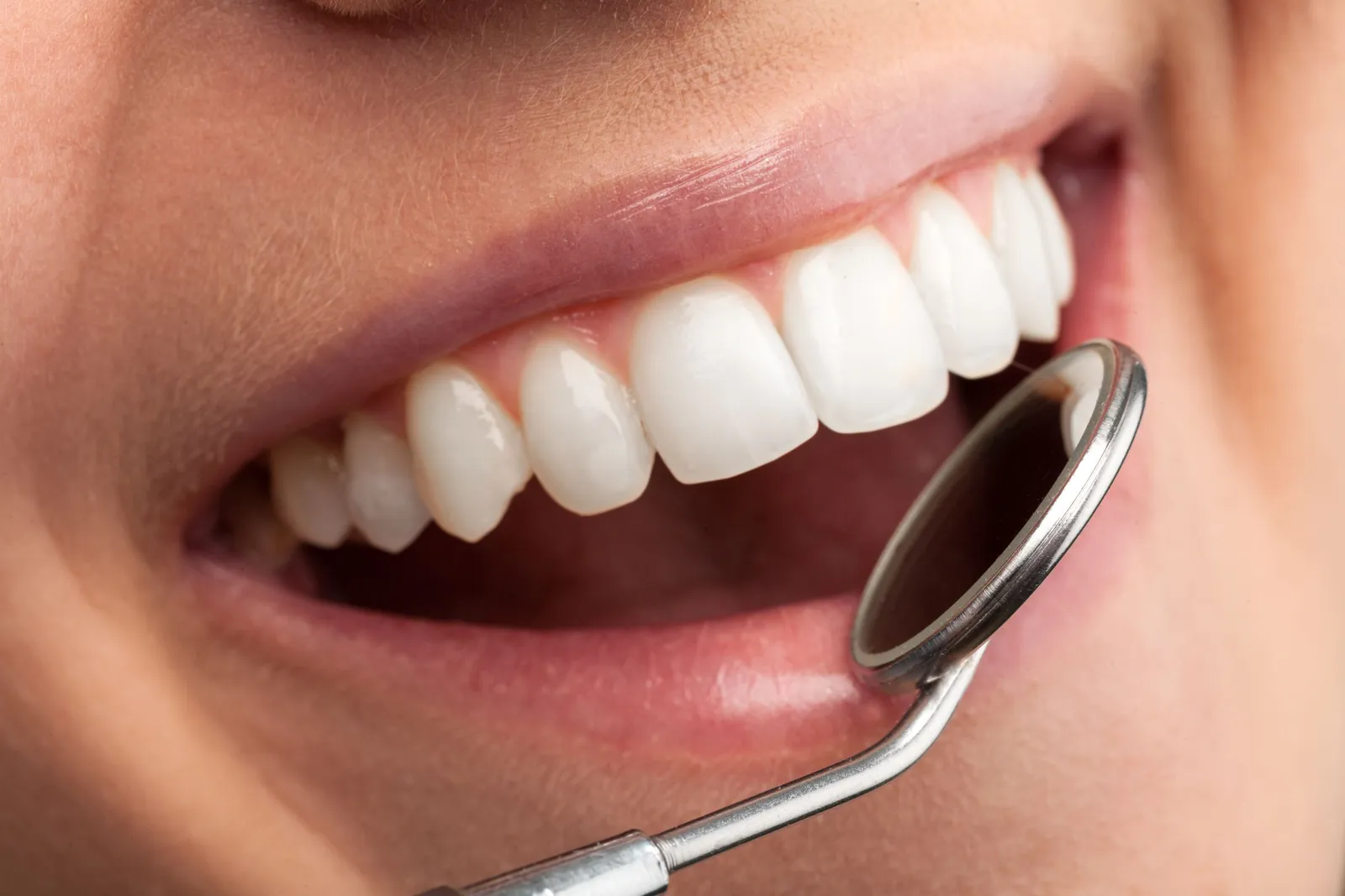 Veneers in Downey: Before & After Timeline, Sensitivity, Cost & Local Case Examples